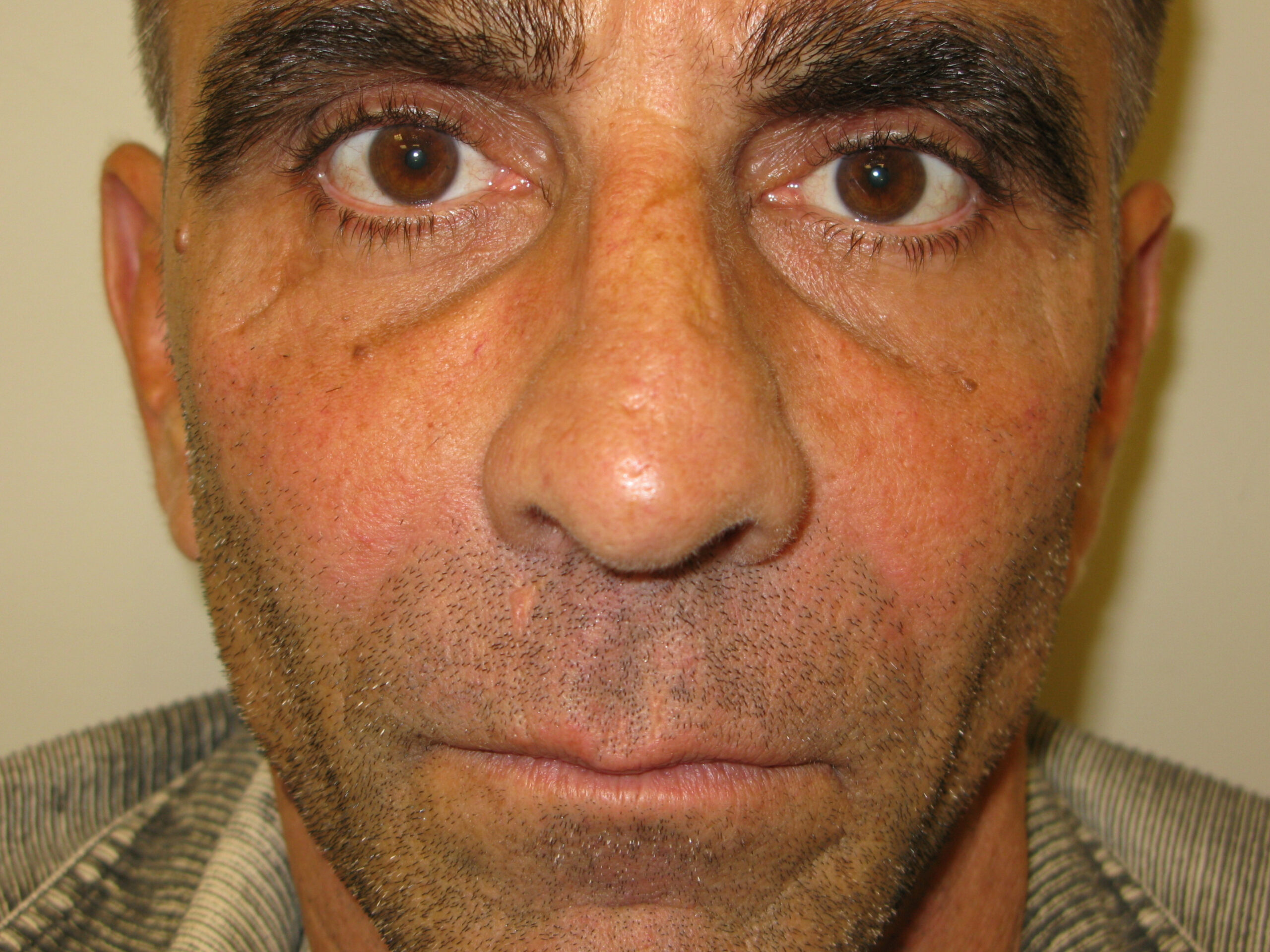 Procedure before and after - after