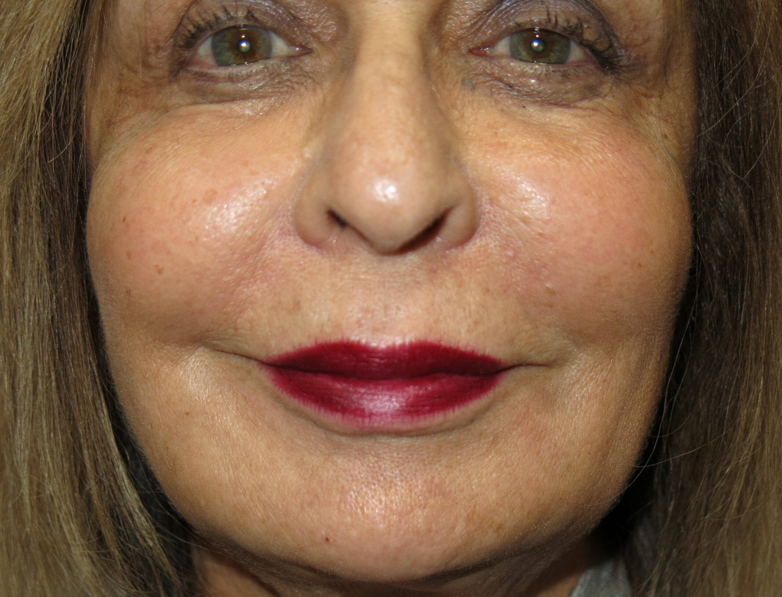 Procedure before and after - after