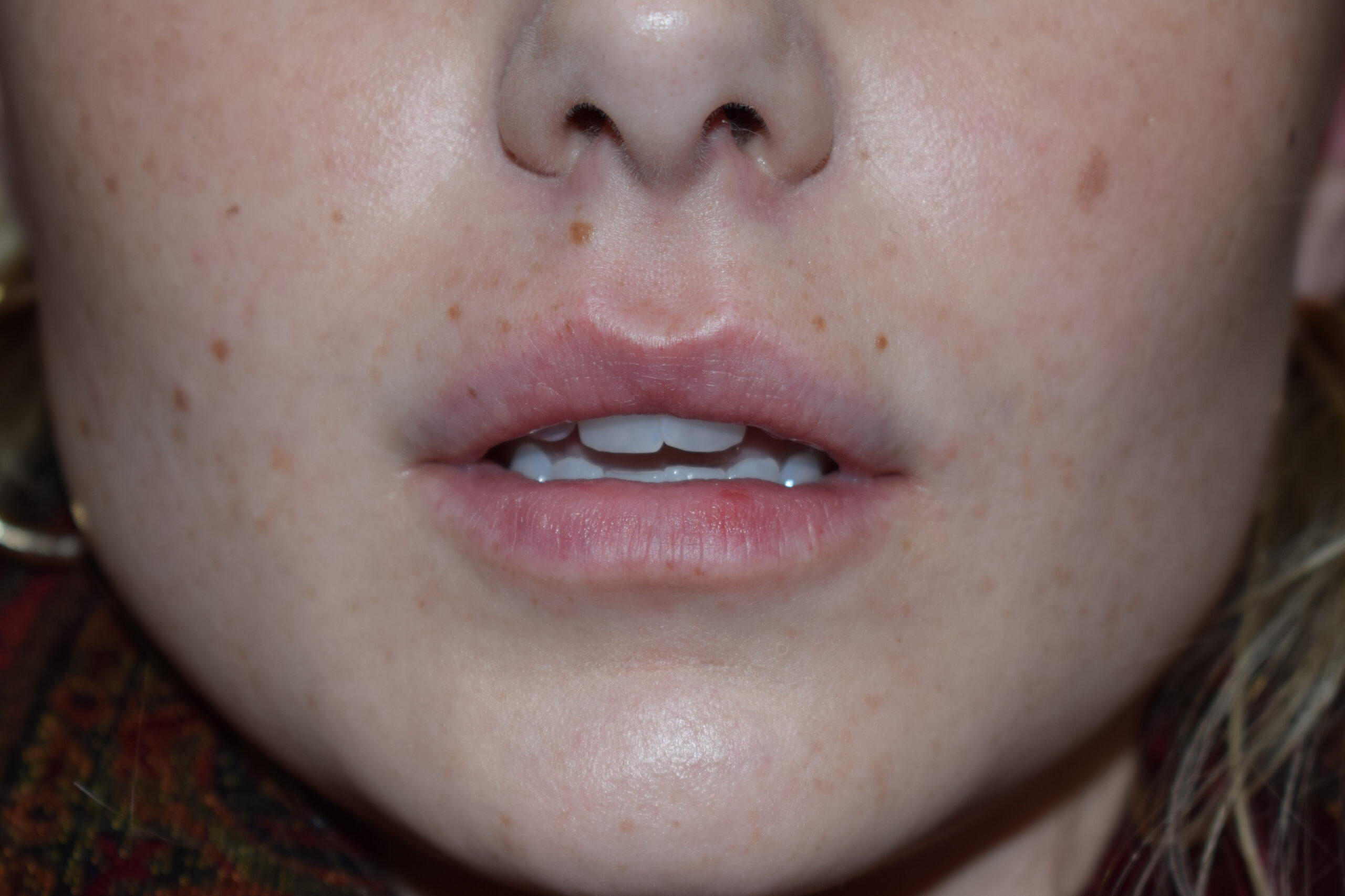 Procedure before and after - after