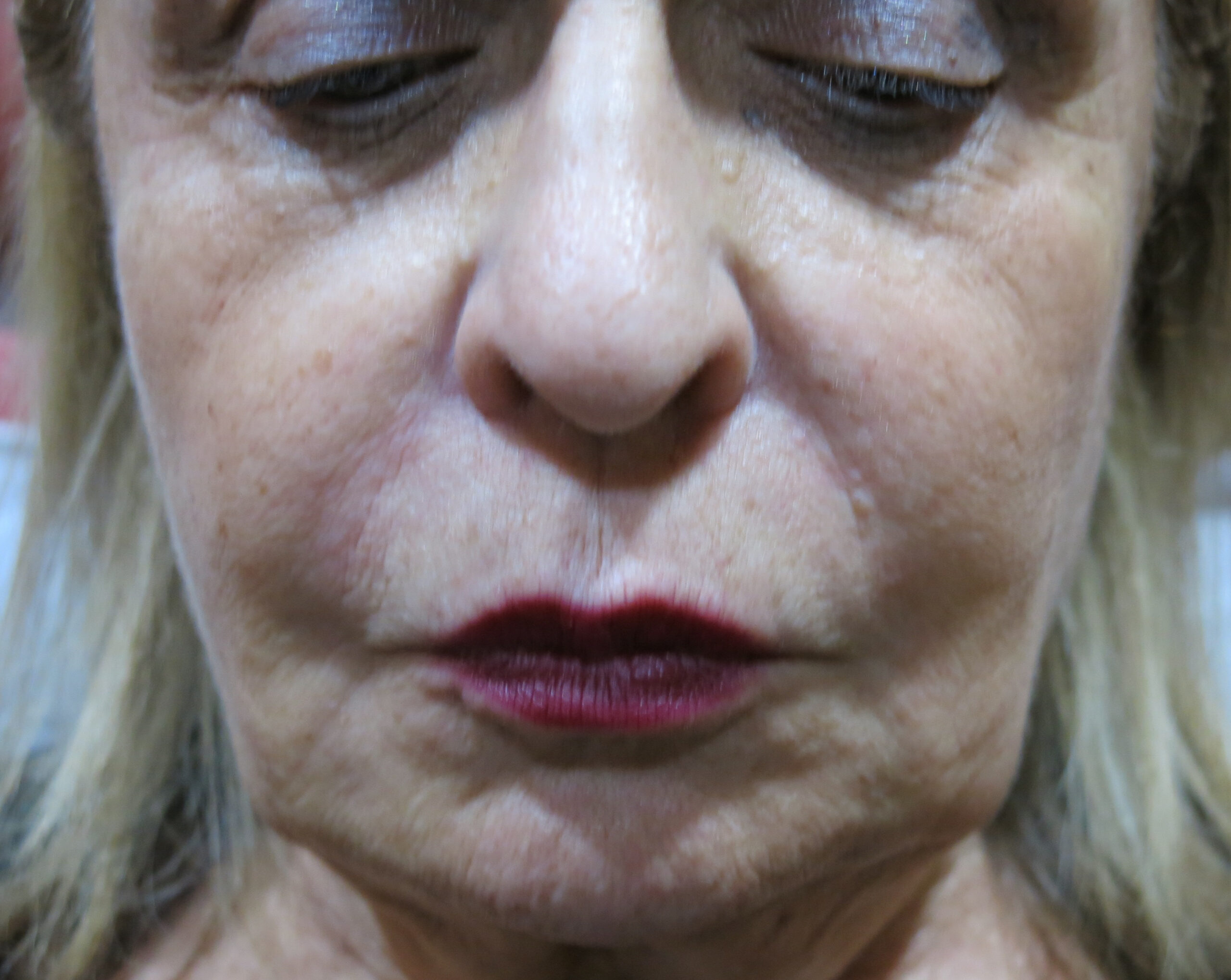 Procedure before and after - before