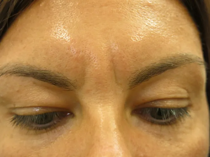 Procedure before and after - before