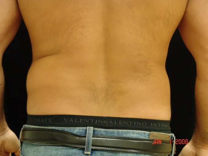 Liposuction before and after - before