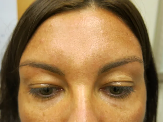 Procedure before and after - before