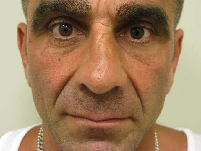 Procedure before and after - before