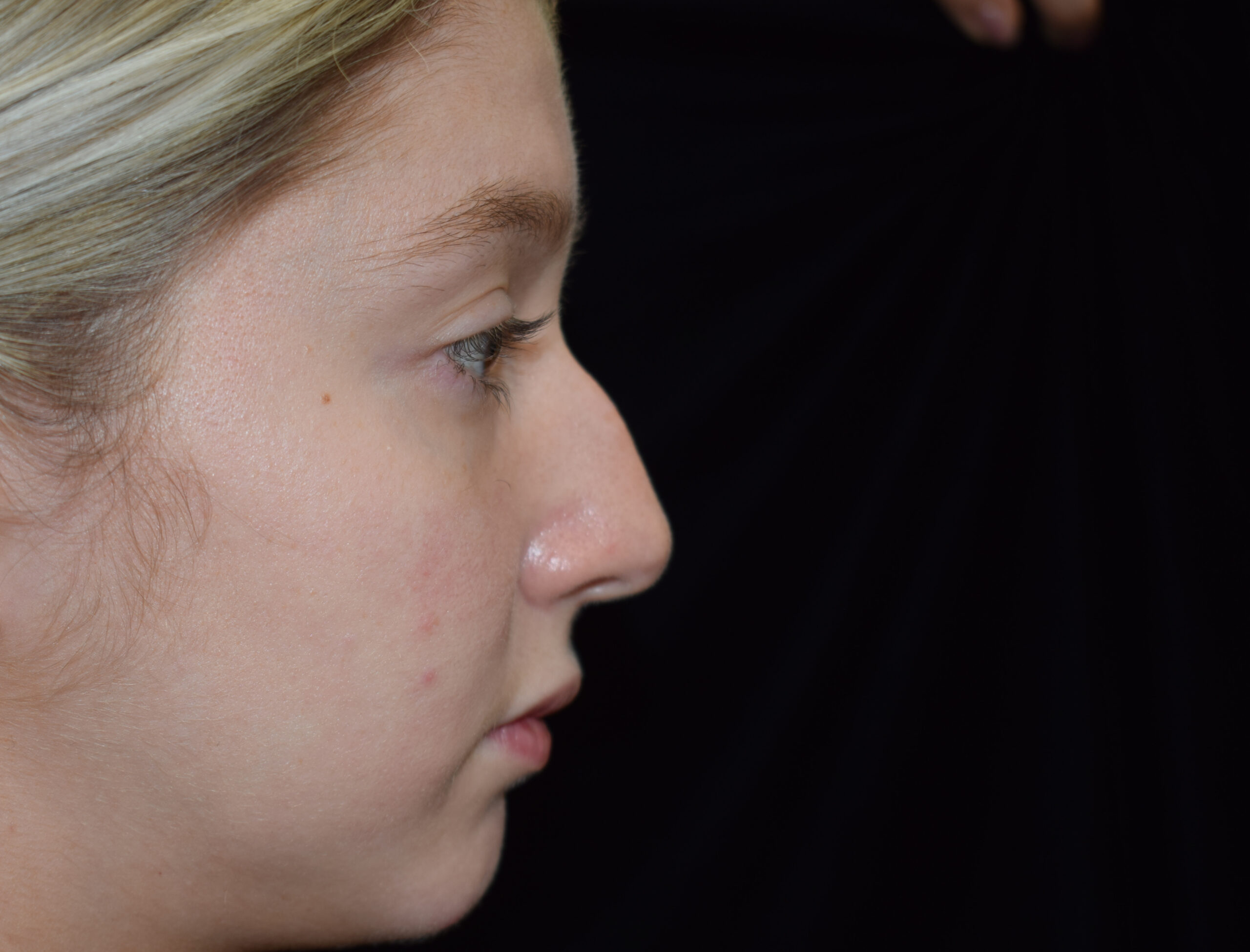 Procedure before and after - before