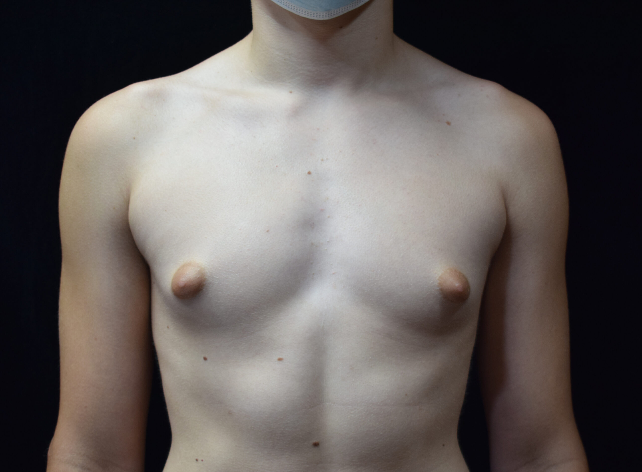Procedure before and after - before