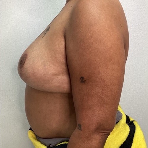 Breast Reduction before and after - after
