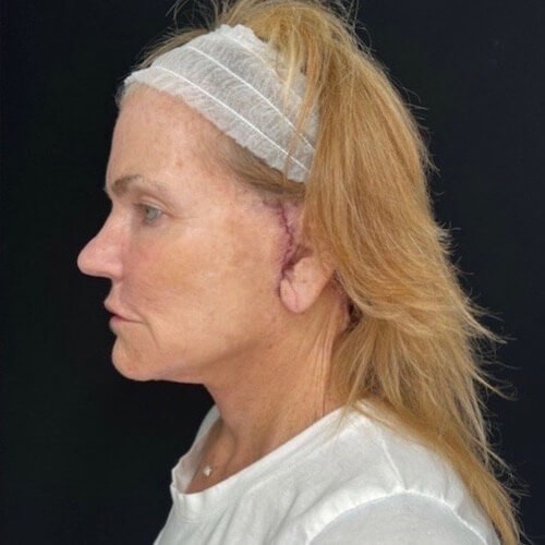 Facelift before and after - after