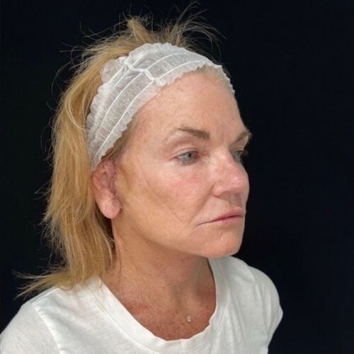 Facelift before and after - after