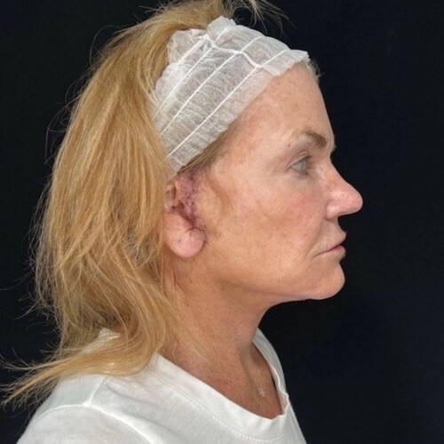 Facelift before and after - after