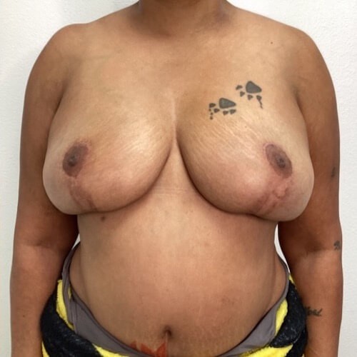Breast Reduction before and after - after