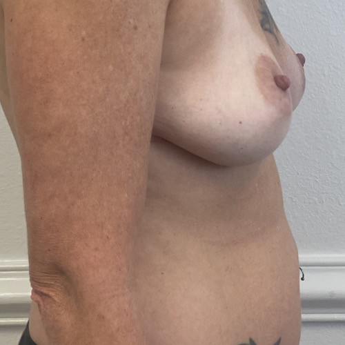 Bbl before and after - before