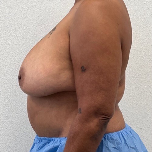 Breast Reduction before and after - before