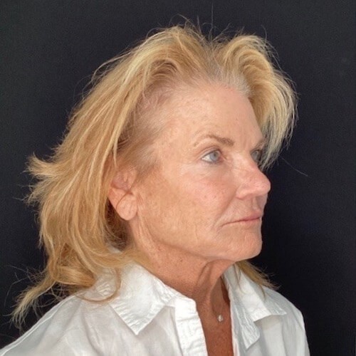 Facelift before and after - before