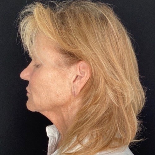Facelift before and after - before
