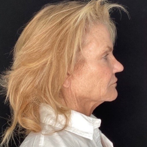 Facelift before and after - before