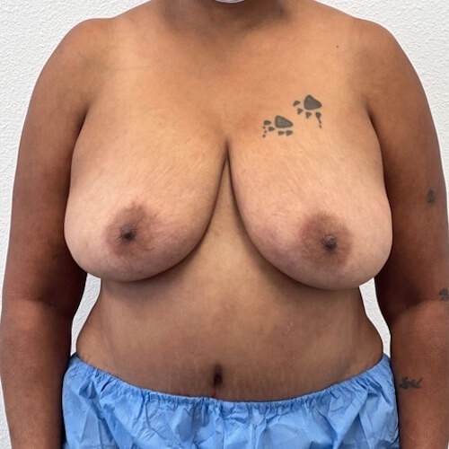 Breast Reduction before and after - before
