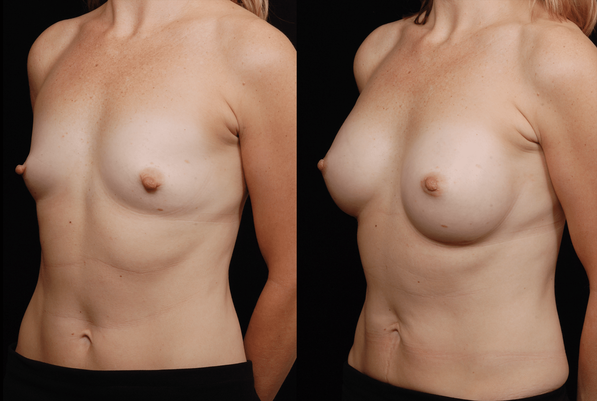 Procedure before and after - after
