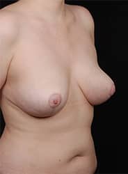 Breast Reduction before and after - after