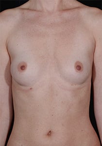 Breast Augmentation before and after - before