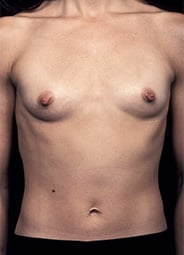 Breast Augmentation before and after - before