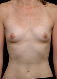 Breast Augmentation before and after - before