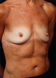 Breast Augmentation before and after - before