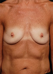 Breast Augmentation before and after - before