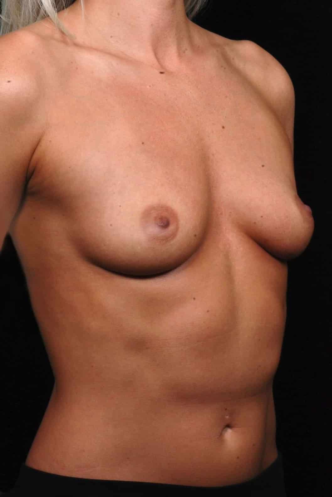 Breast Augmentation before and after - before