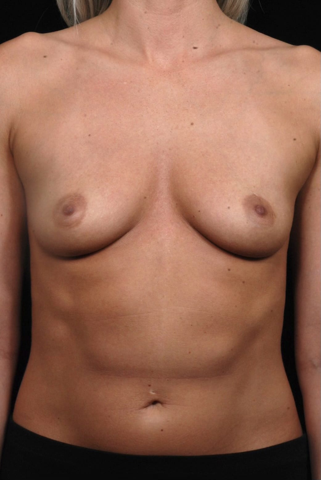 Breast Augmentation before and after - before