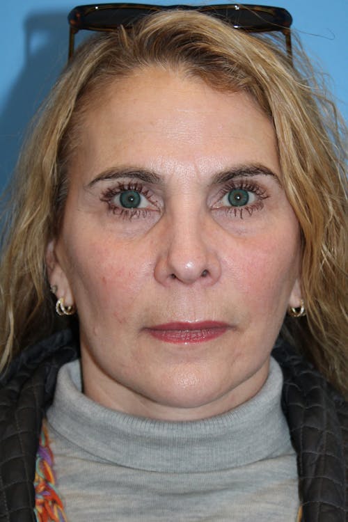 Facelift before and after - after