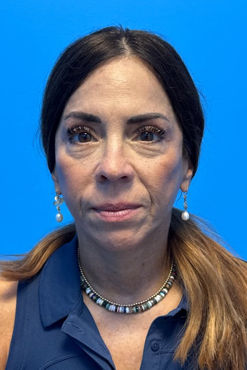 Blepharoplasty before and after - after