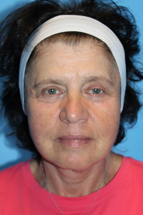 Facelift before and after - after