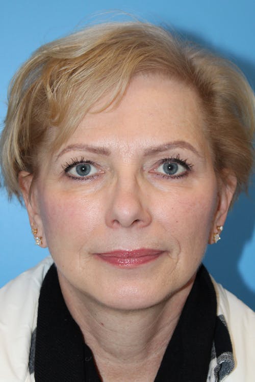 Facelift before and after - after
