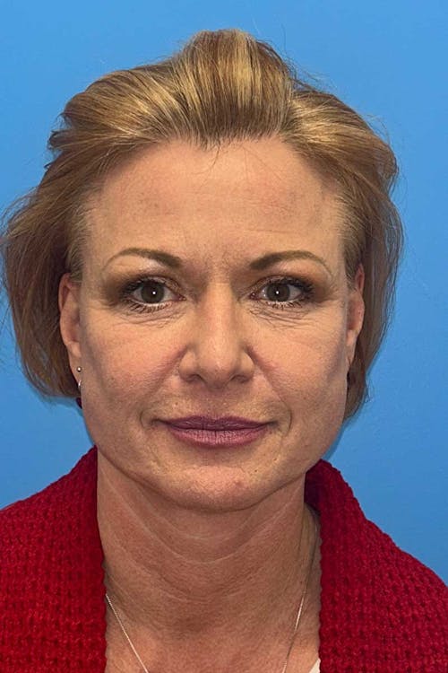 Facelift before and after - after