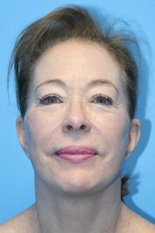 Facelift before and after - after