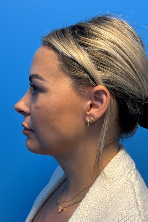 Chin before and after - after