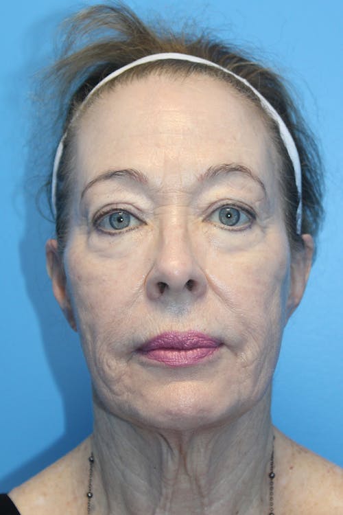 Facelift before and after - before