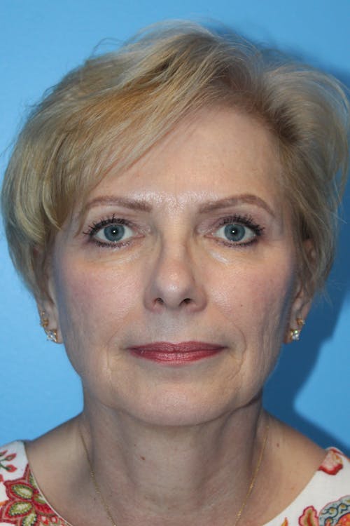 Facelift before and after - before