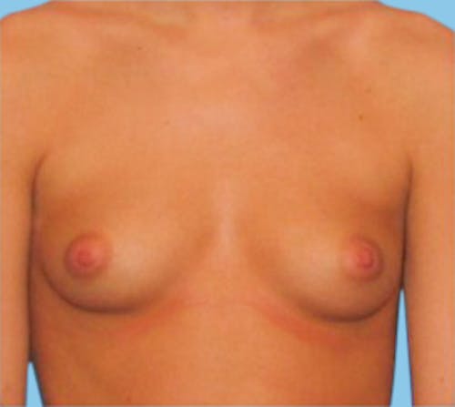 Breast Augmentation before and after - before