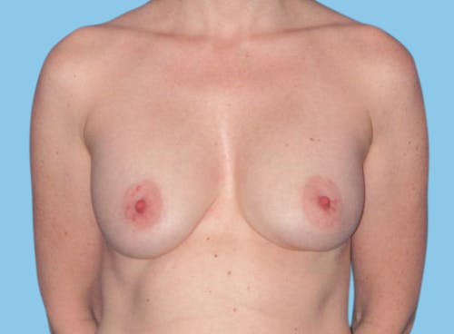 Breast Augmentation before and after - before