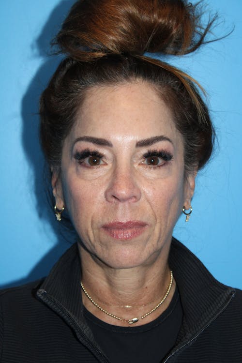 Blepharoplasty before and after - before