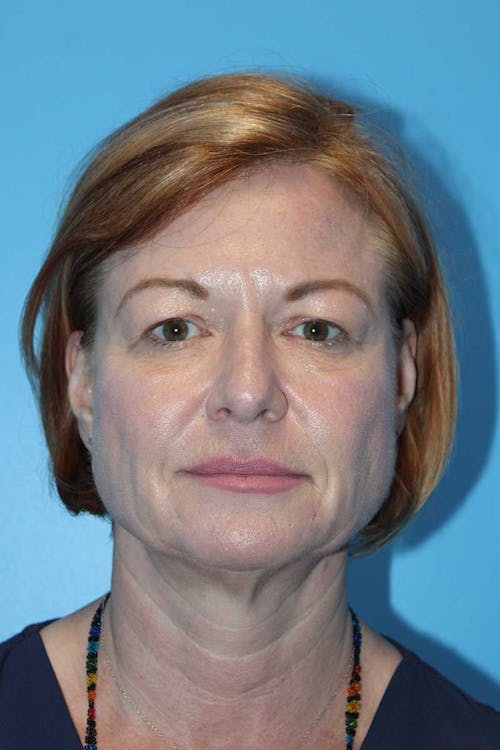 Facelift before and after - before