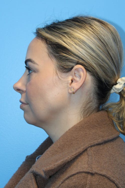 Chin before and after - before