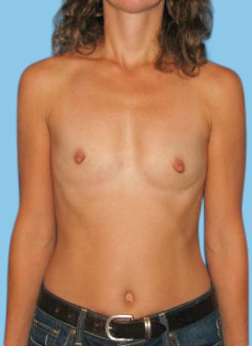 Breast Augmentation before and after - before