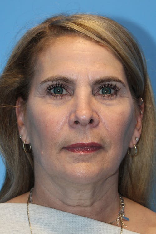 Facelift before and after - before