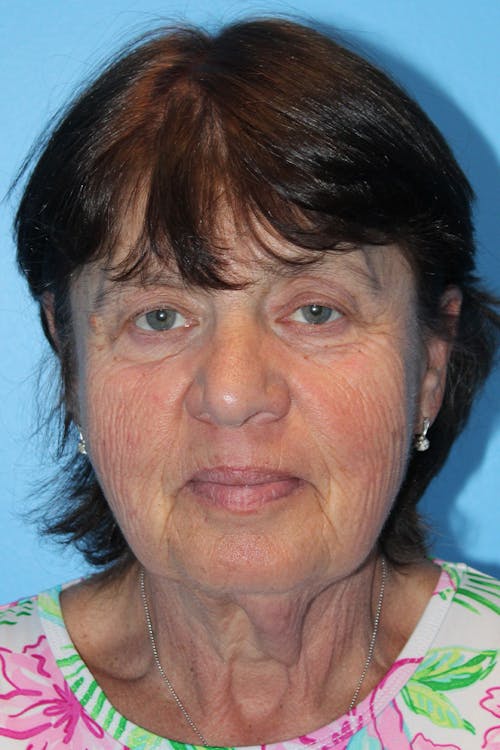 Facelift before and after - before