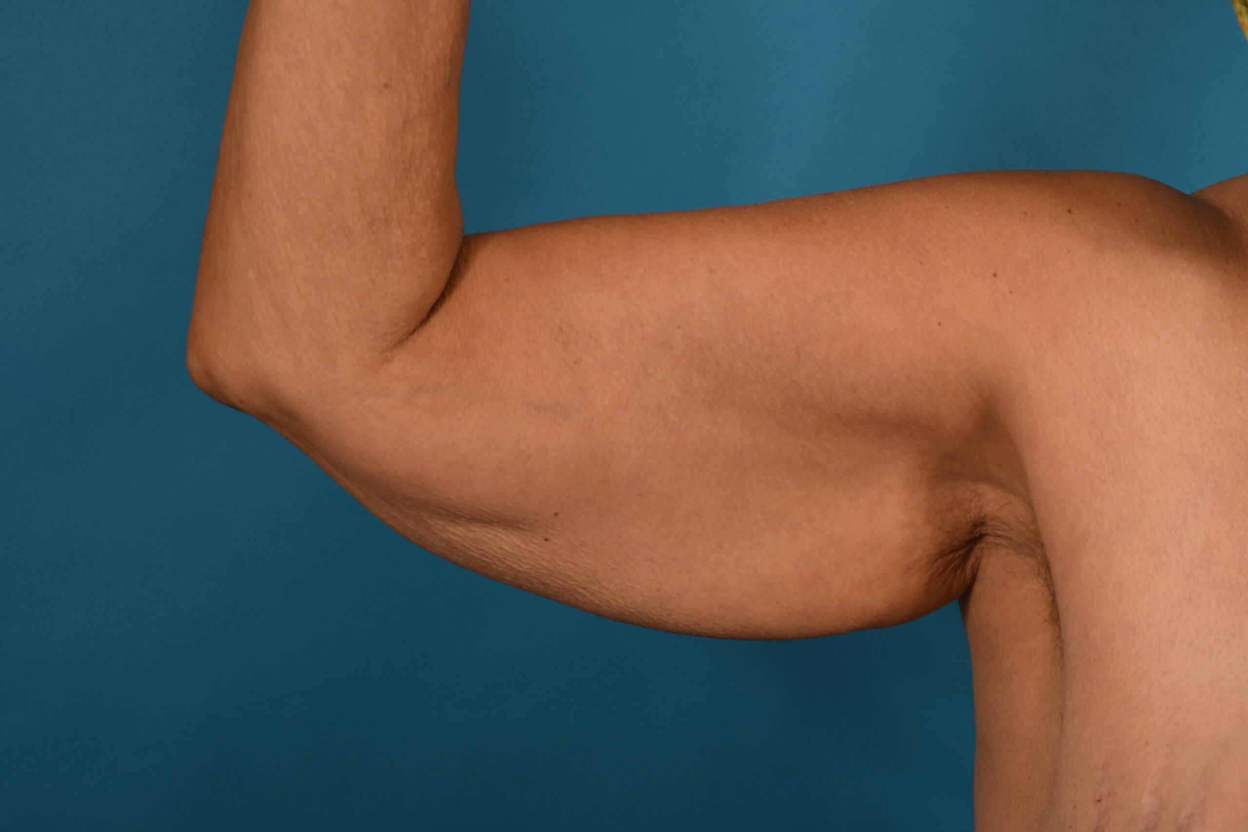 Arm Lift after — Dr. Denis Branson