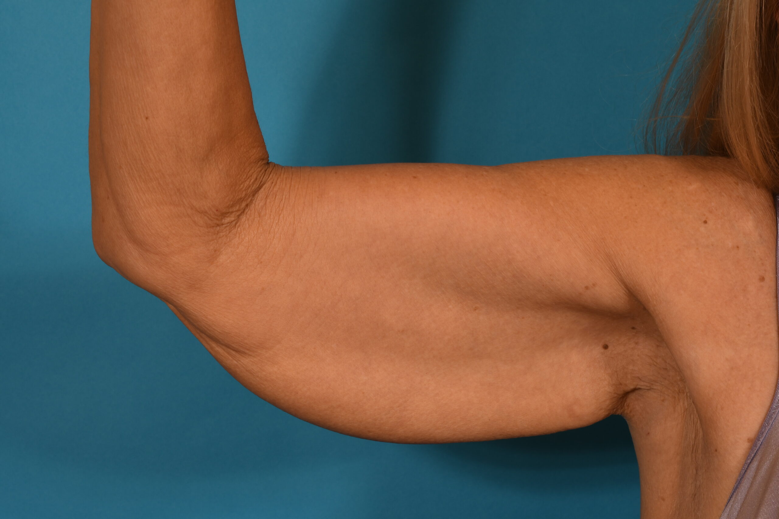 Arm Lift after — Dr. Denis Branson