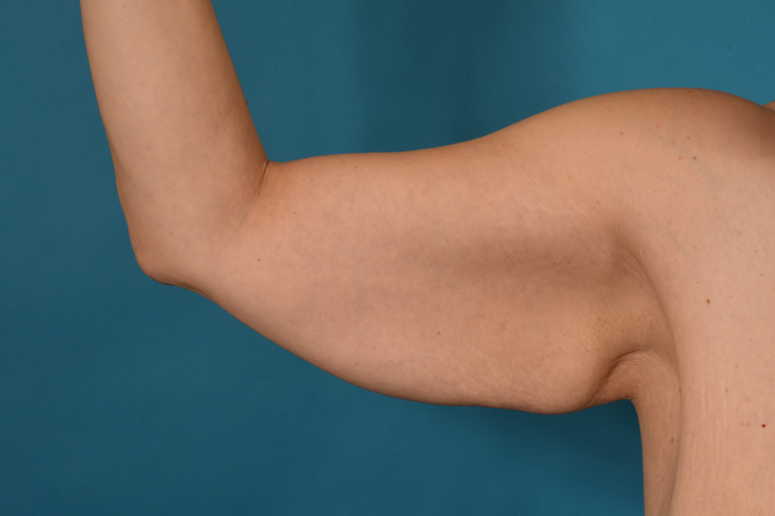 Arm Lift after — Dr. Denis Branson
